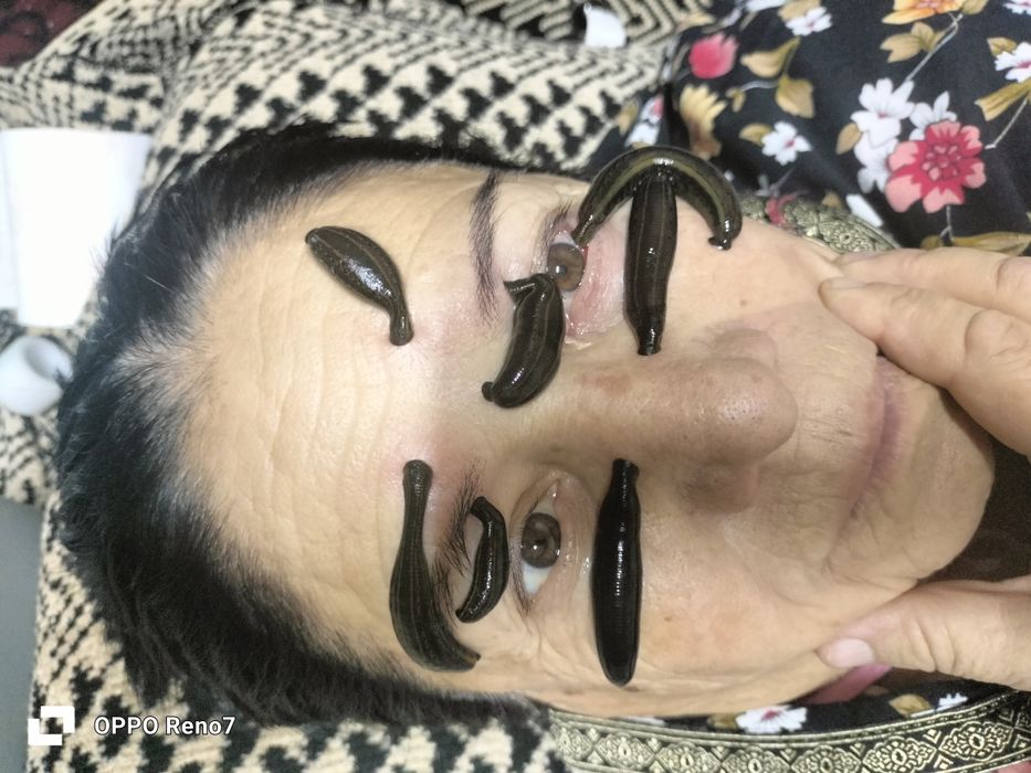 зулук пиявки гирудотерапия