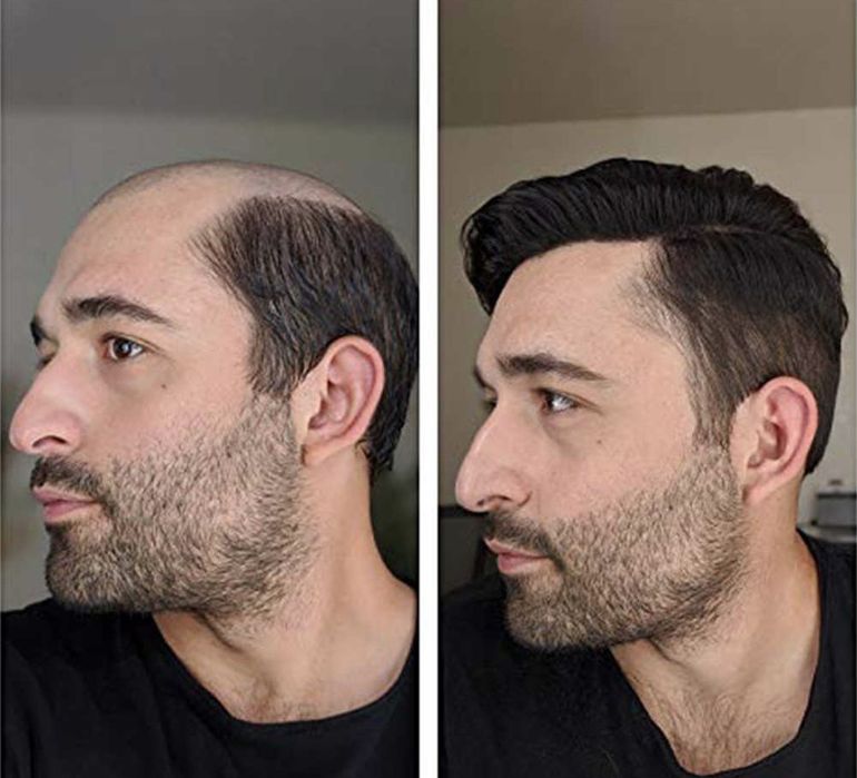 Мужской парик Алматы (система замещения волос)