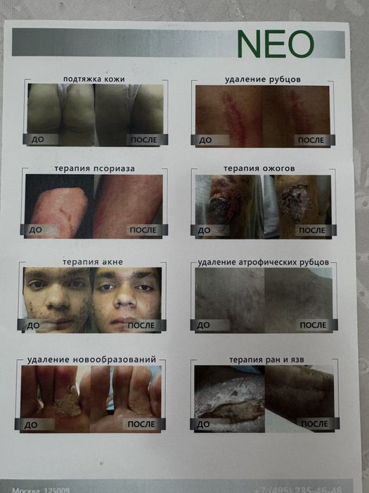 Продам лазерный аппарат Aerolase