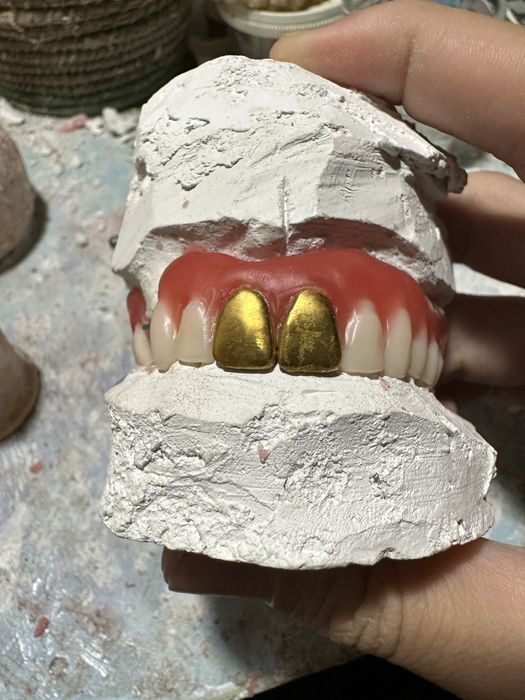 Изготовление сьемных протезов