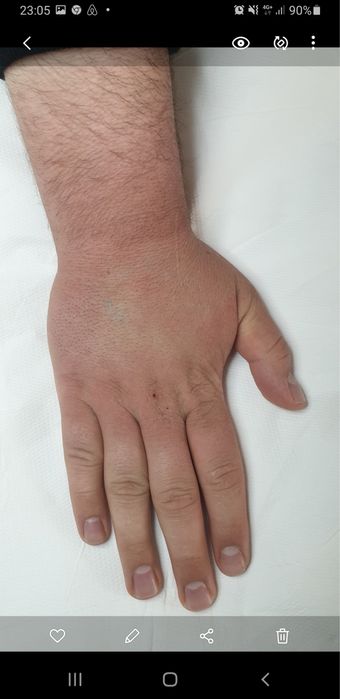 Laser scoatere tatuaj corporal si facial