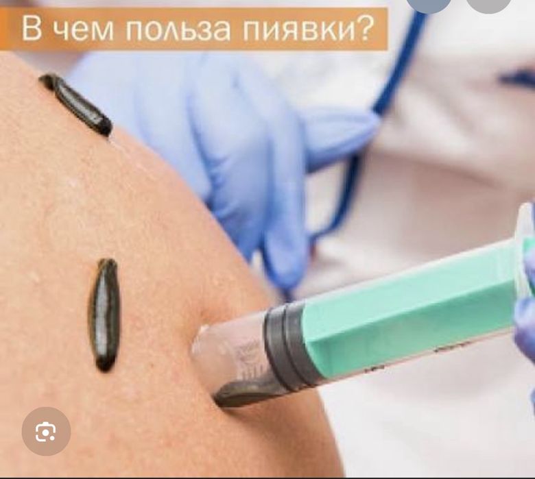 Личение пиявками, сулікпен емдеу