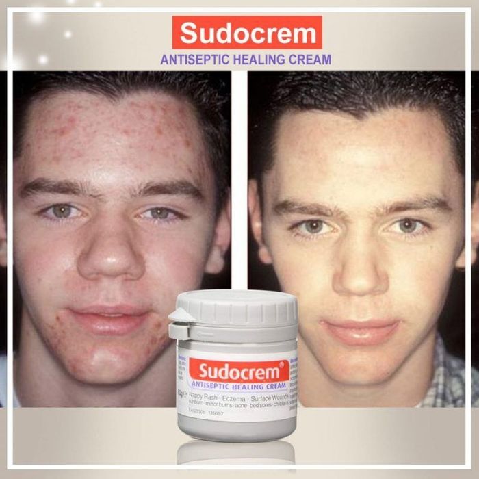 Suda krem ugrilarni bir zumda ketqazadi toshnalarni yoqotadi.