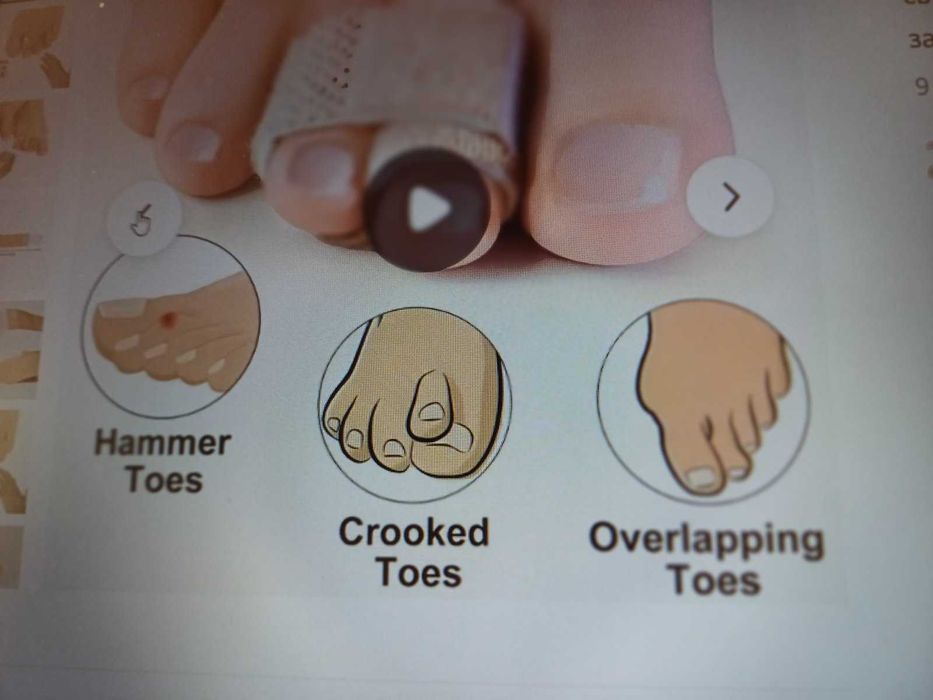 фиксатор и чорапче за пръстите на краката