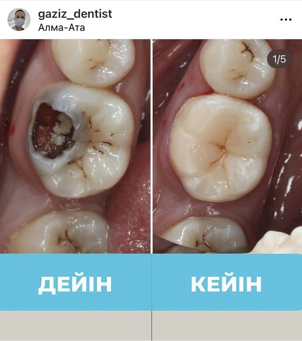 Алматы тіс емдеу , стоматолог