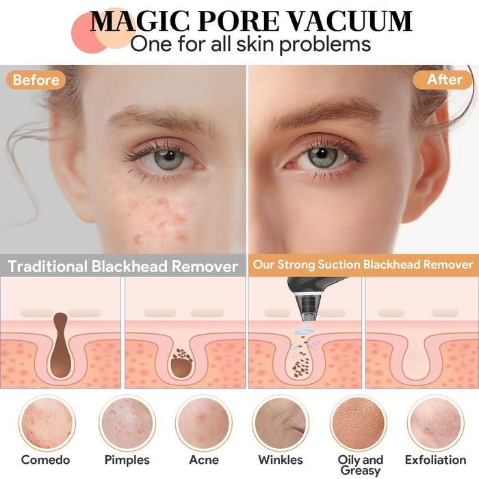 ТОП Уред за почистване на лице с вакуум срещу черни точки