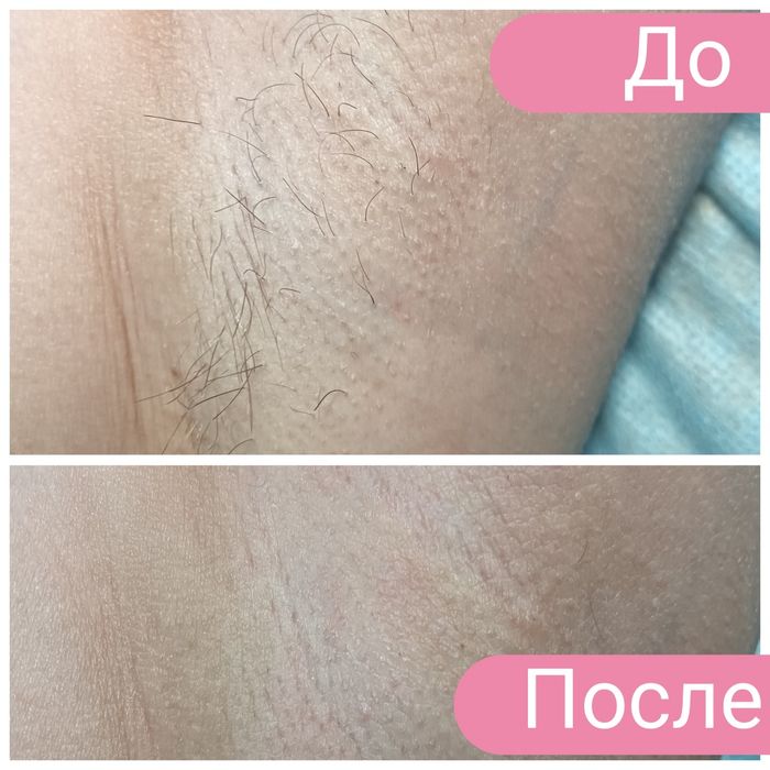 Шугаринг для милых дам