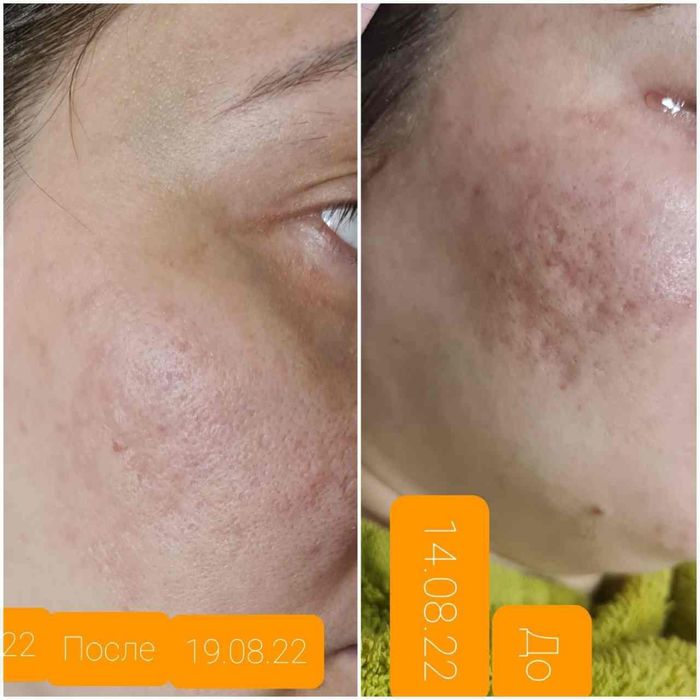 Косметологические услуги (мужчины и женщины) ,фуллфейз ботокс, губы