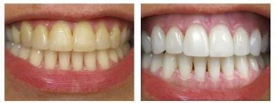 Albire dentară profesională cu gutiere personalizate – la tine acasă!