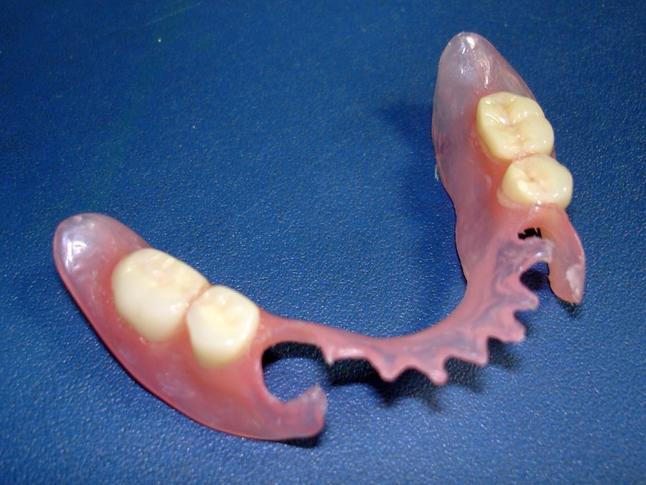 Изготовление сьемных протезов