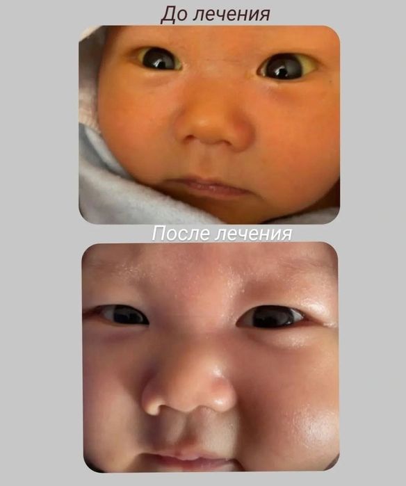 Fotolampa. Fototerapiya. Фотолампа. Фототерапия. Аренда. Ijara