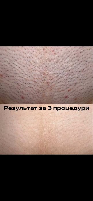 Лазерная Эпиляция в Самарканде -50% скидка на первое посещение!