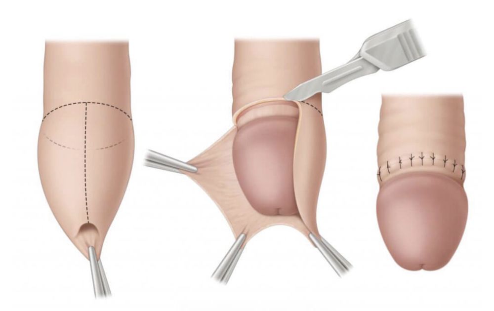 Обрезание. Сундет. Лазер. Безболезненно. Выезд на дом.