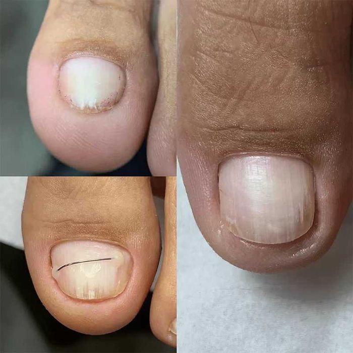 Afectiuni Unghii si Talpi - Podologie doar cu asistenti medicali