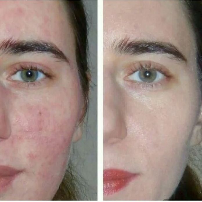 Прогестероновый дерматит фото Прогестероновый дерматит фото