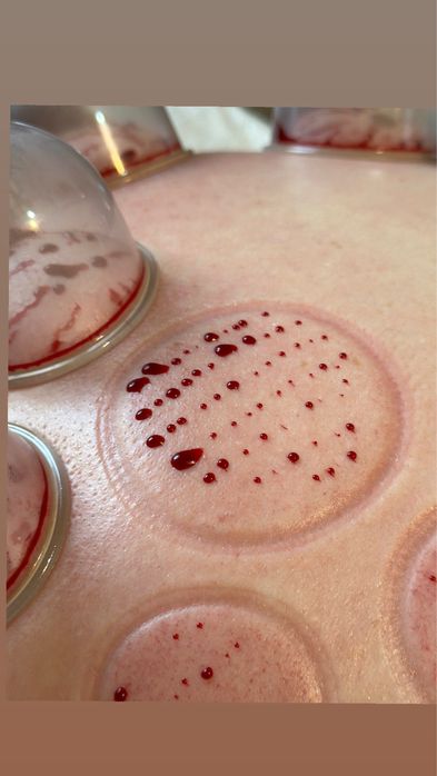 Хиджама лечебная