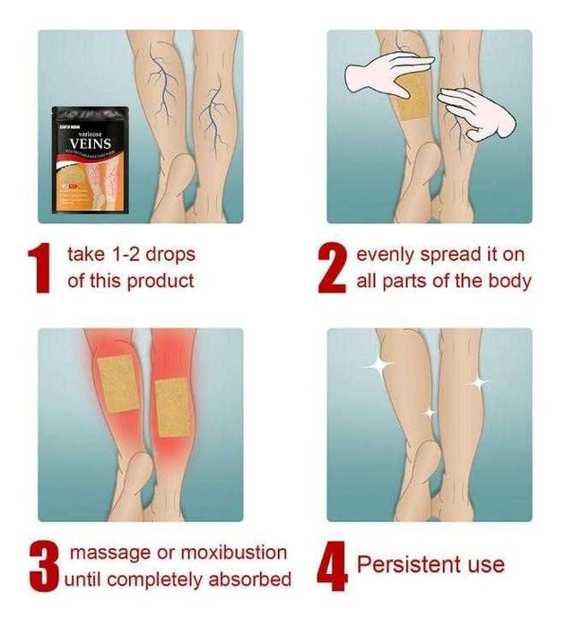 12 броя Пластир за Разширени Вени Лепенка за Лечение на Разширени Вени