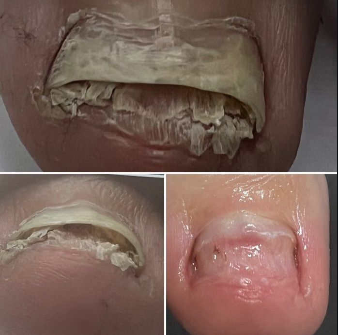 Подология лечение стоп и ногтей