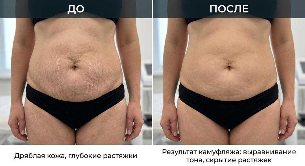Камуфляж растяжек и шрамов. Требуются модели
