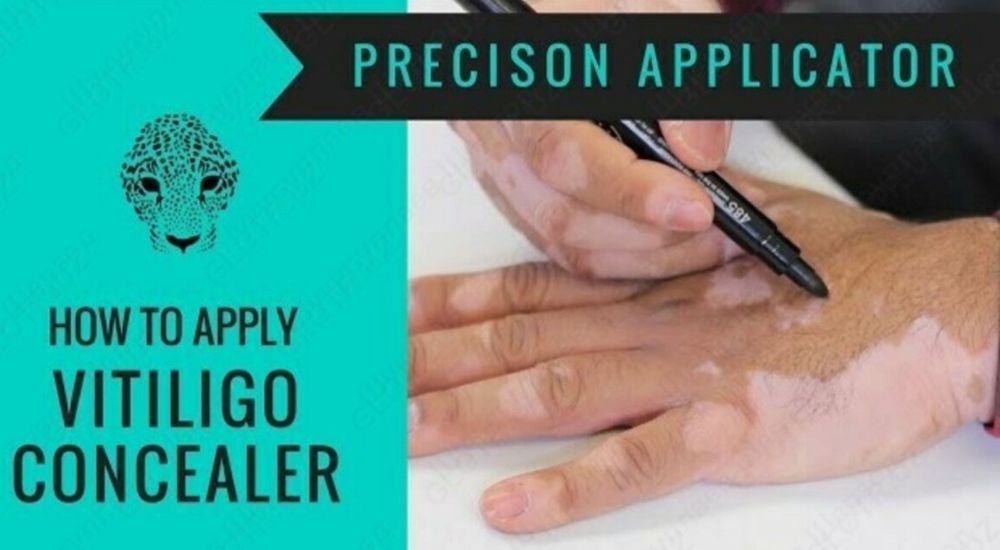 Фломастер от витилиго.Vitiligo uchun flomaster