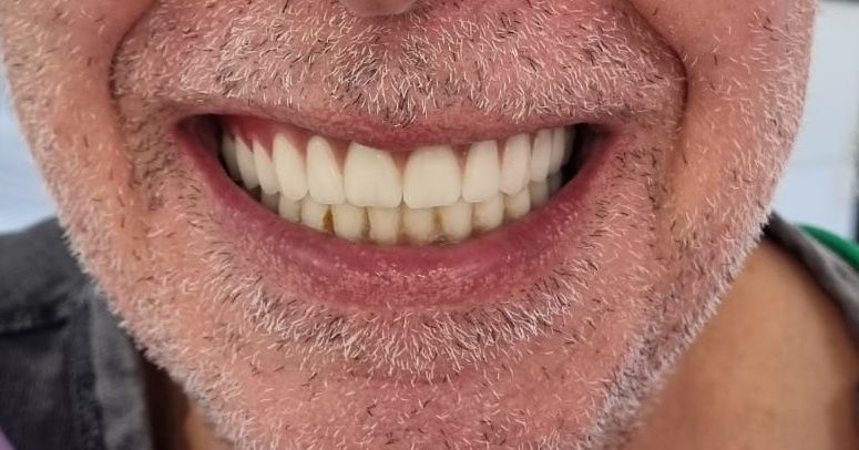 Tehnica dentara proteze dentare