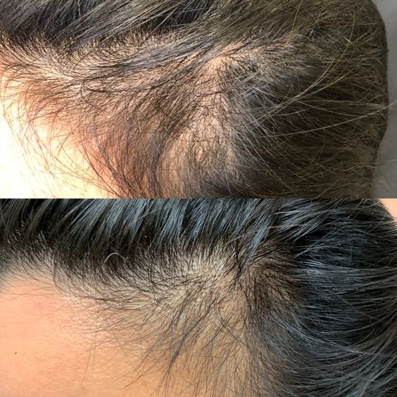 Soch tushishi yoki alopesiya bilan qiynalayapsizmi?Shifokor dermatolog