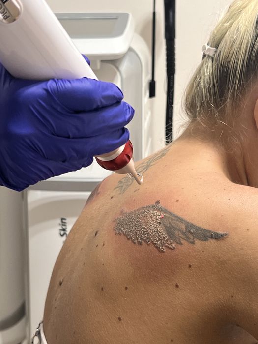 Aparat scos tattuaje , pelling carbon
