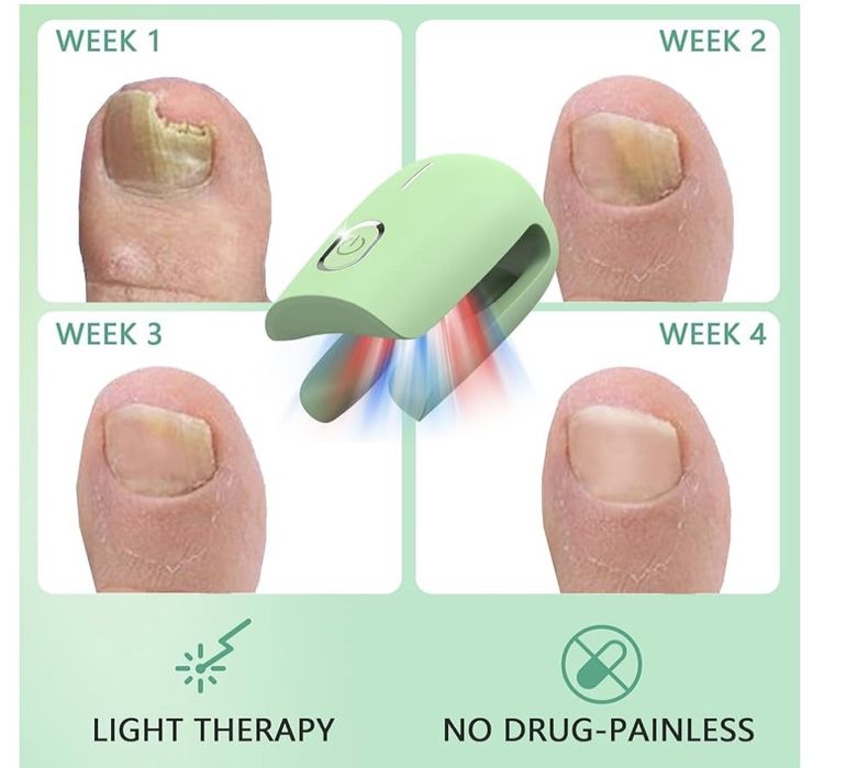 Dispozitiv de tratament cu laser pentru ciuperca unghiilor iKeener