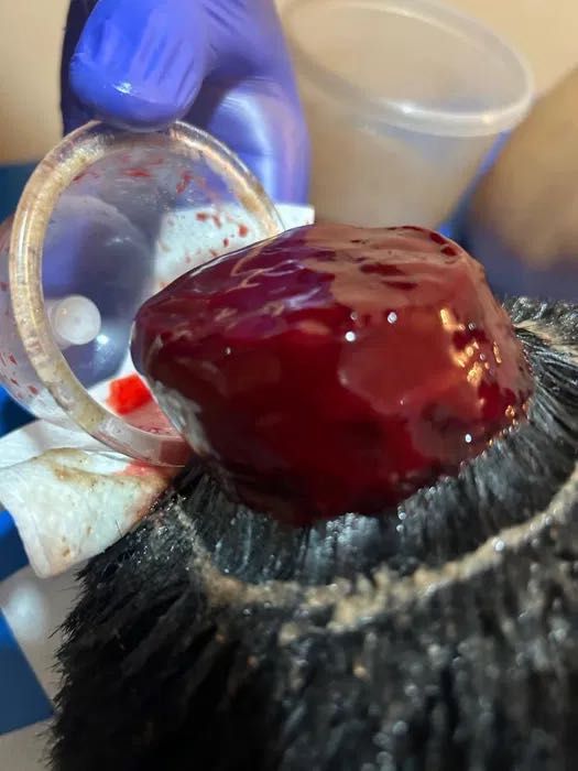 Хиджама и пиявки Астана