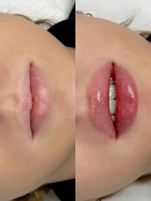 Увеличение губ Алматы 25000