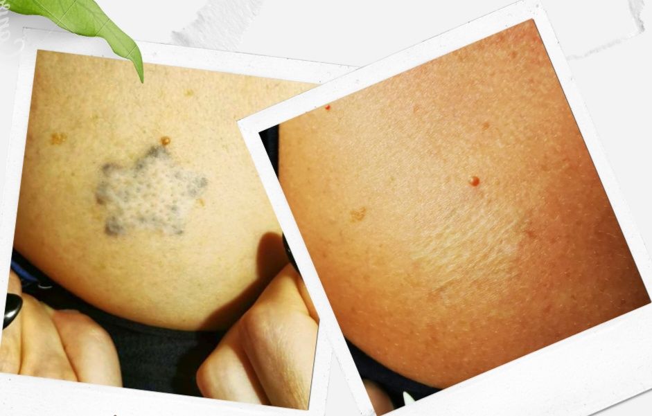 Îndepartare - stergere tatuaje pico laser laser