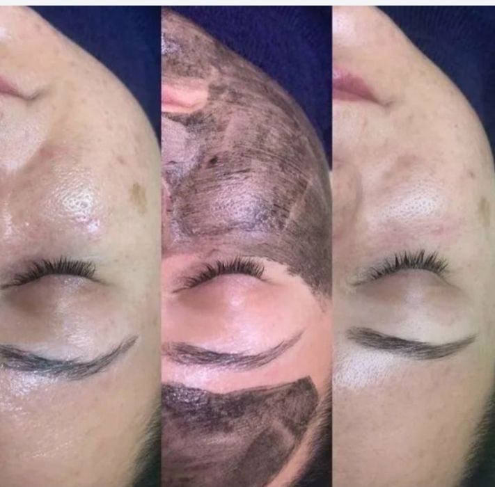 Удаление лазером тату от 5000, карбоновый пилинг 7000