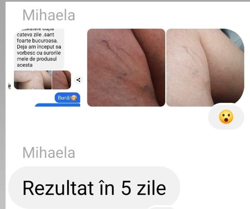 Cum am scăpat eu de durerile de picioare,picioare grele și umflate!