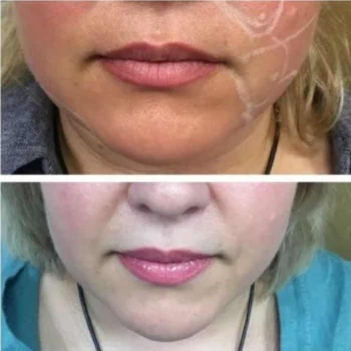 Липолитики. Живот, бедра, лицо, второй подбородок.