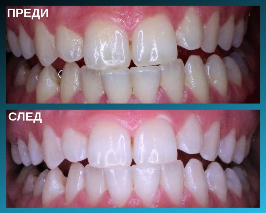 Bright Lens – лепенки за освежаване на усмивката