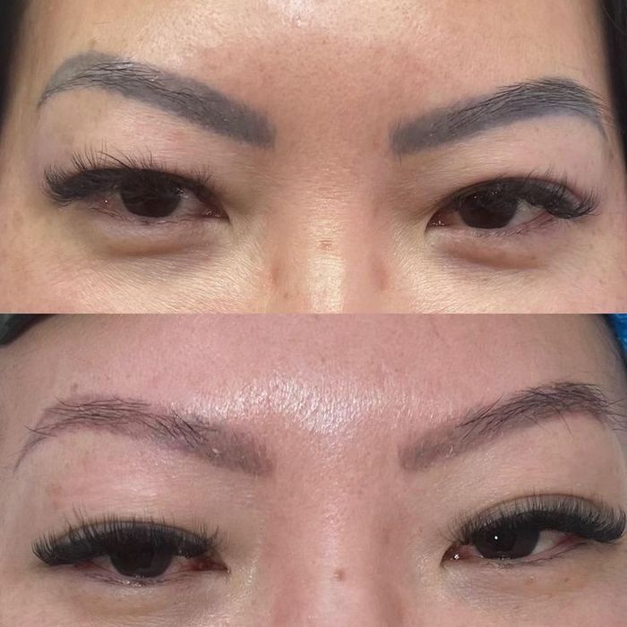 Лазерное удаление татуажа 5000