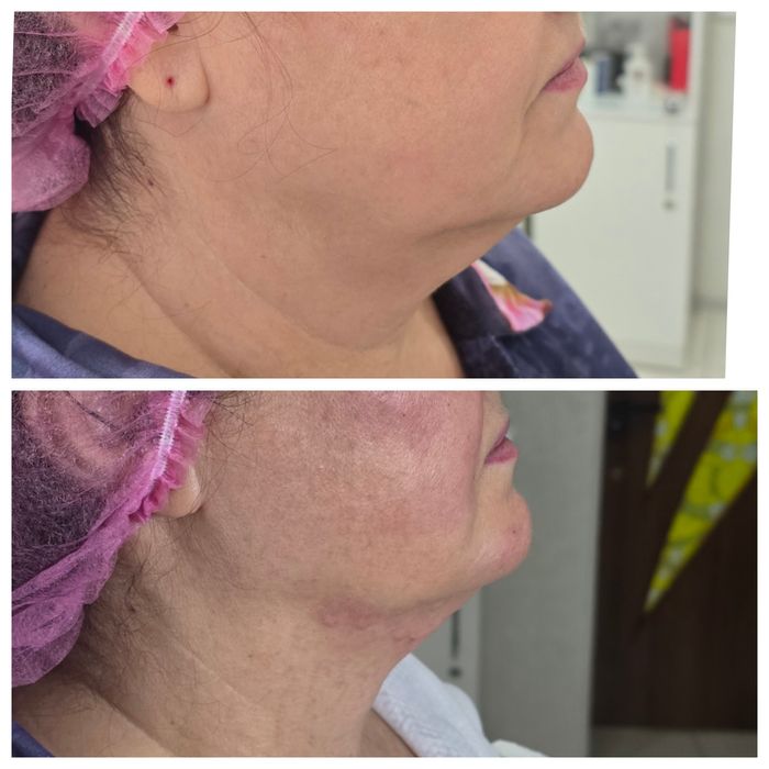 МиМикроигольчатый РФ лифтинг