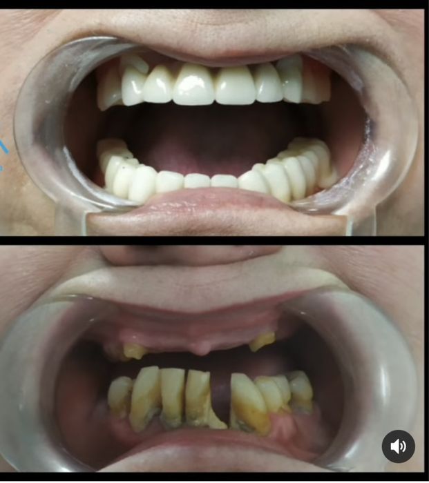 Металлокерамика . Зубные коронки.