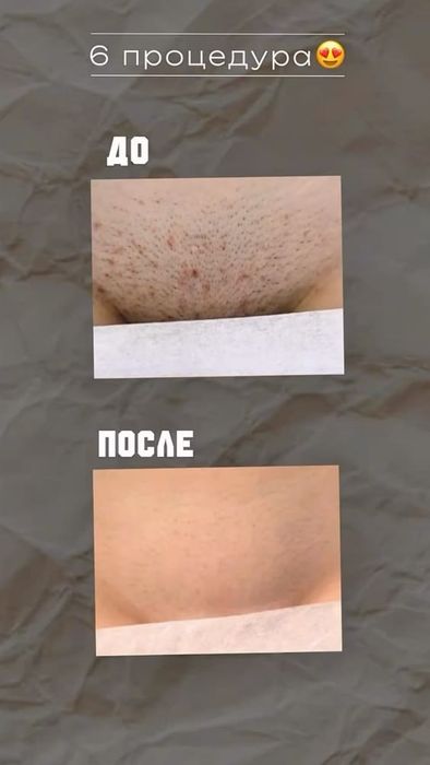 Обучение лазерной эпиляции