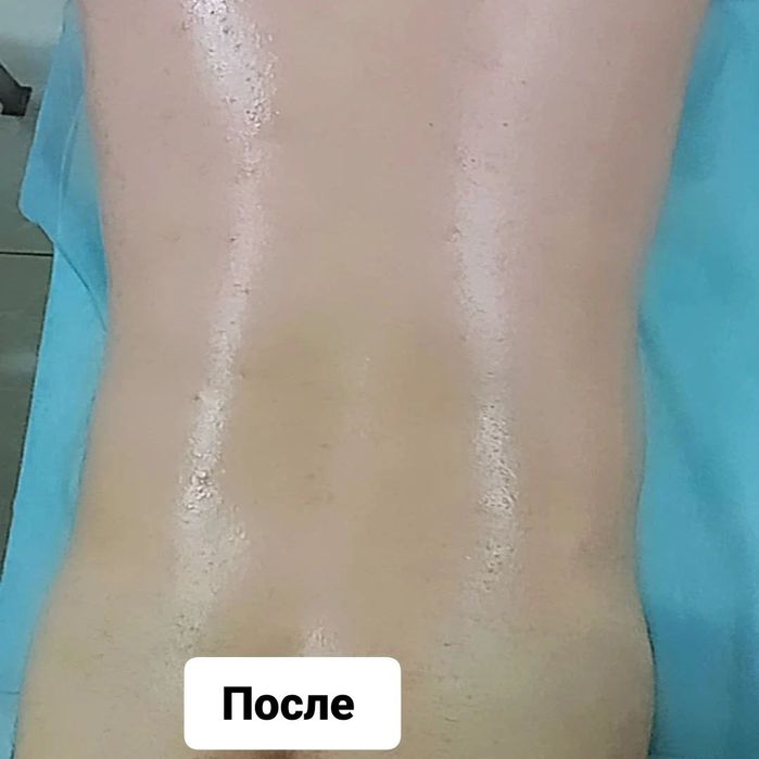 Лазерный епилатция и депилатсия для мужчина