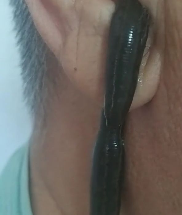 Лечение пиявками . Обучение