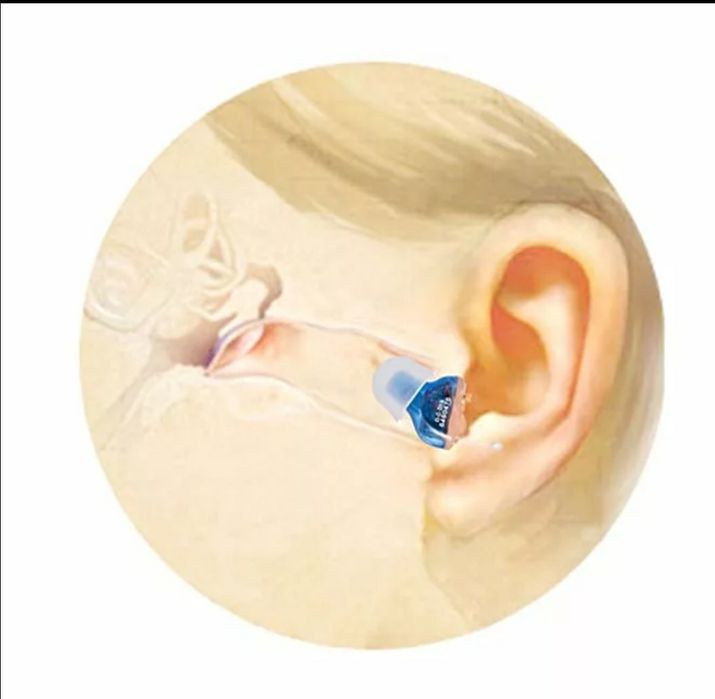 Внутри канальный слуховой аппарат