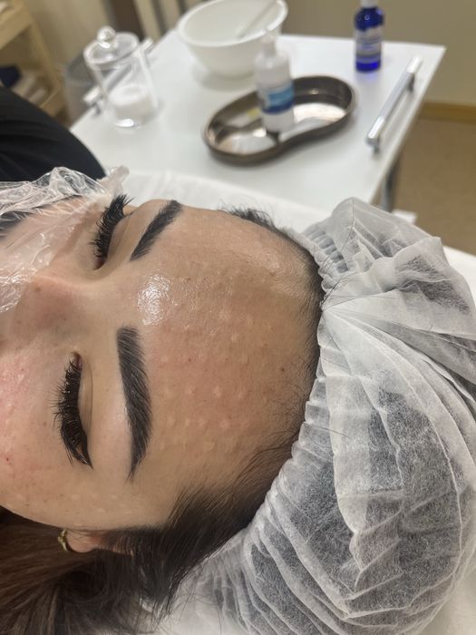 Увеличение губ,мезо,ботокс 30.000