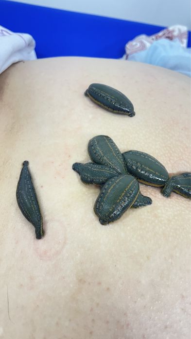 Лечение пиявками, сүлікпен емдеу