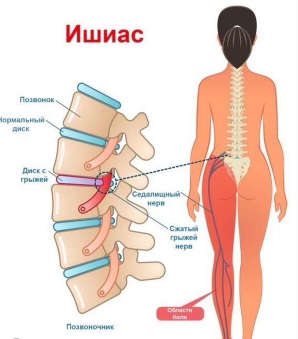 Массаж при Защемлении.