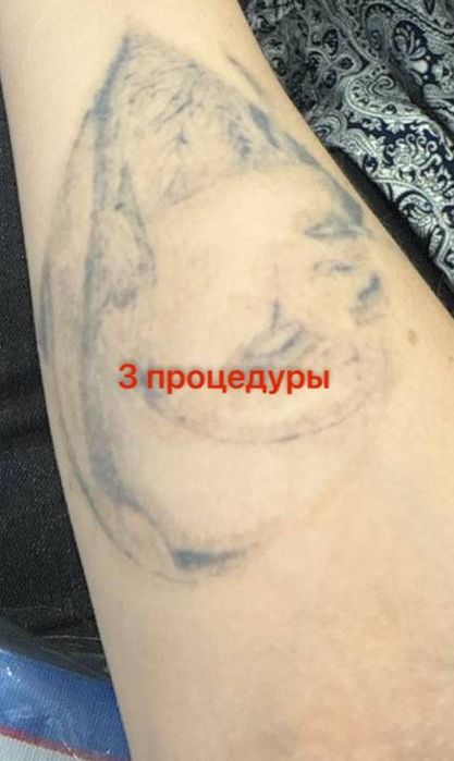 Удаление тату, растушевки (губ и бровки),пигментации