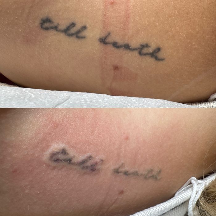 Stergere tatuaje cu laser nd:Yag