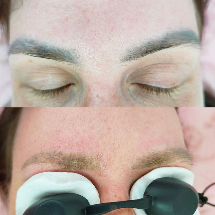 Удаление татуажа, тату