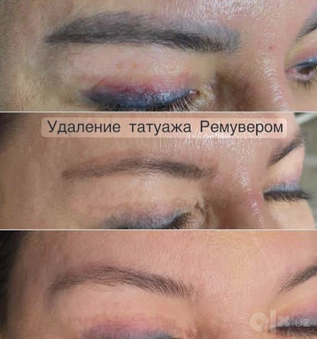 Удаление татуажа ремувером