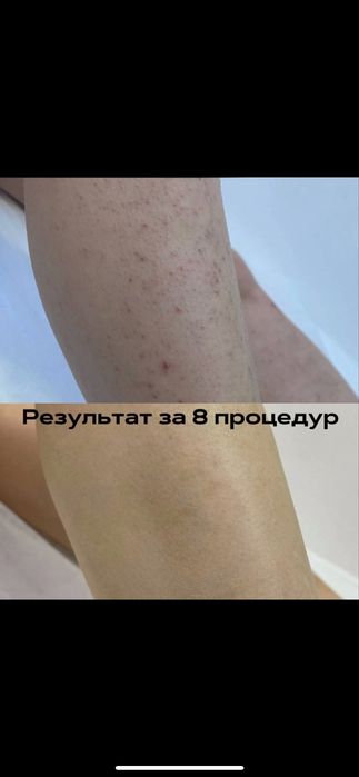 Лазерная Эпиляция в Самарканде -50% скидка на первое посещение!